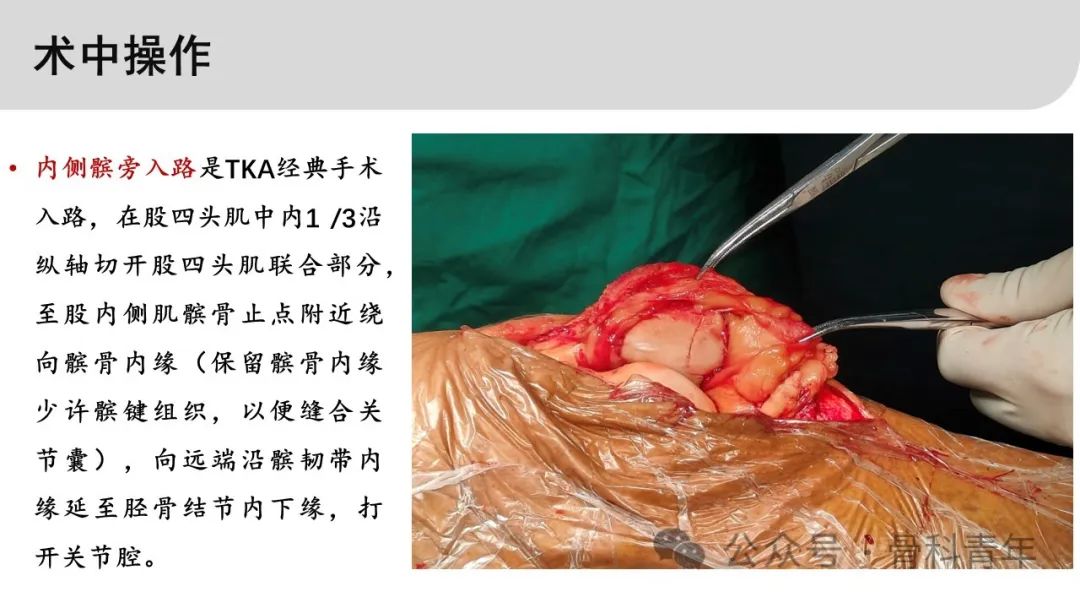 【病例实战】TKA内侧髌旁入路切口在髌骨骨折复位中的应用