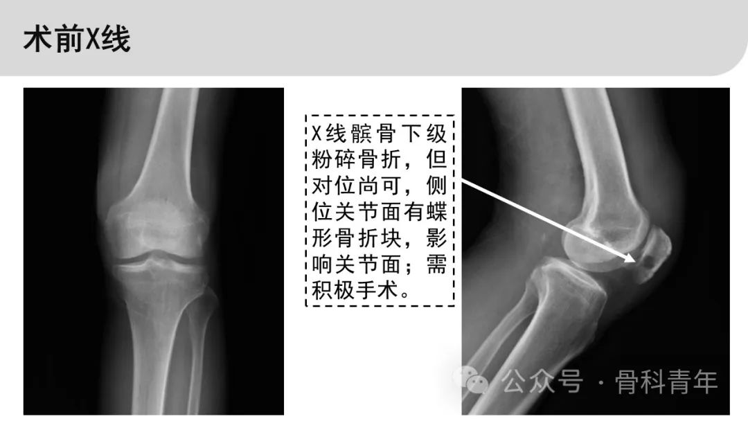 【病例实战】TKA内侧髌旁入路切口在髌骨骨折复位中的应用