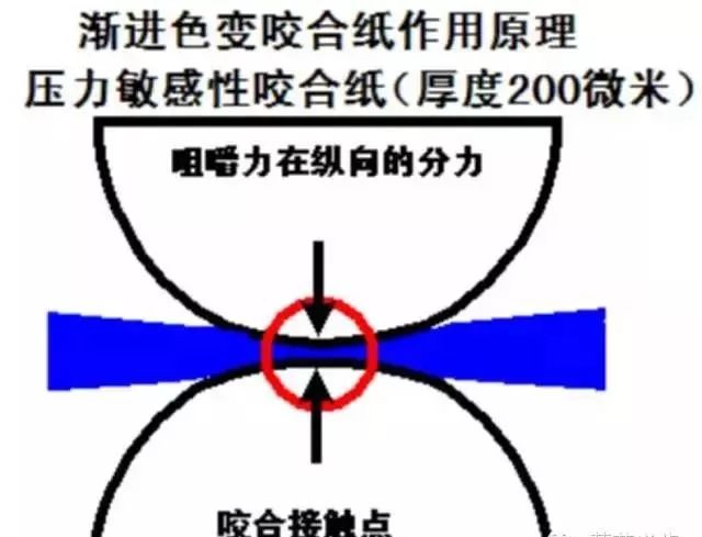 咬合创伤六步检查法！高清多图，一文掌握！