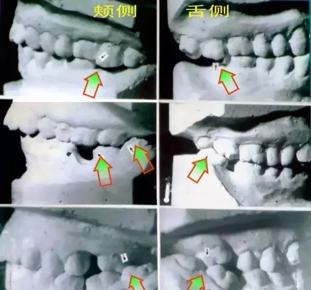 咬合创伤六步检查法！高清多图，一文掌握！