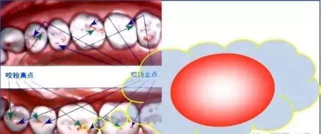 咬合创伤六步检查法！高清多图，一文掌握！