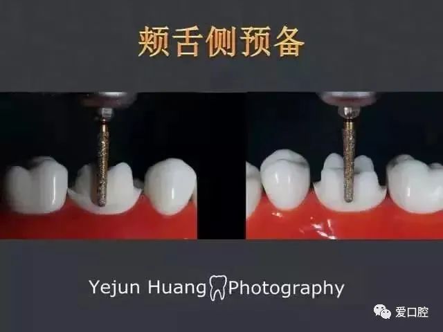后牙的标准牙体制备流程