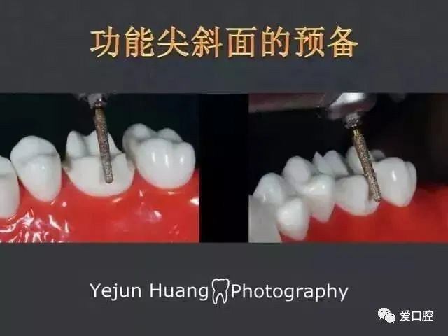 后牙的标准牙体制备流程