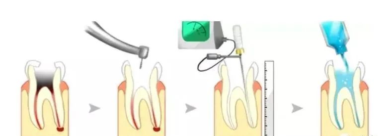 想要乳牙根管治疗做的优秀，这10个细节一定要把握！