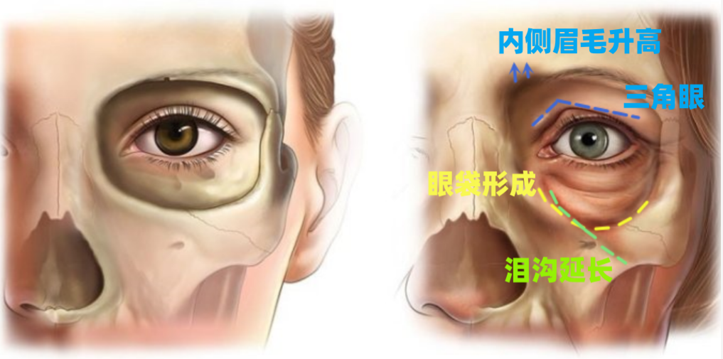 眶骨变化对眼周外貌影响的底层逻辑