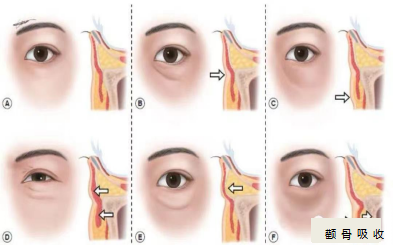 眶骨变化对眼周外貌影响的底层逻辑