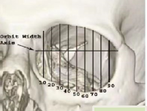 眶骨变化对眼周外貌影响的底层逻辑