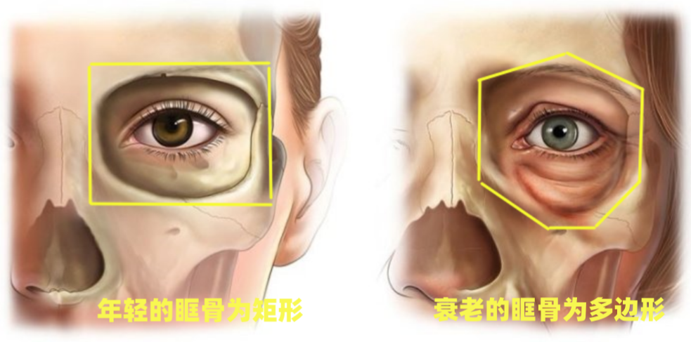 眶骨变化对眼周外貌影响的底层逻辑