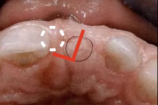 种植二期手术如何选择合适的切口？