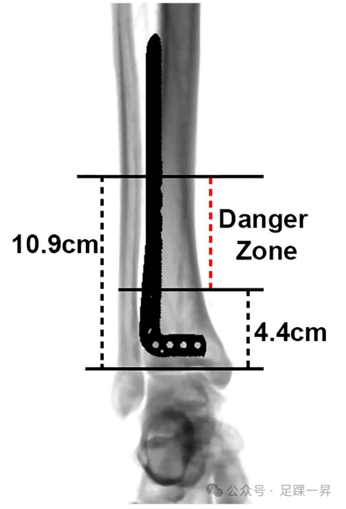 【手术技巧】胫骨远端前外侧钢板之危险区