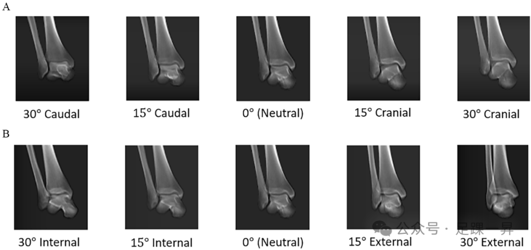 踝关节骨折——透视角度旋转对评估腓骨长度影响