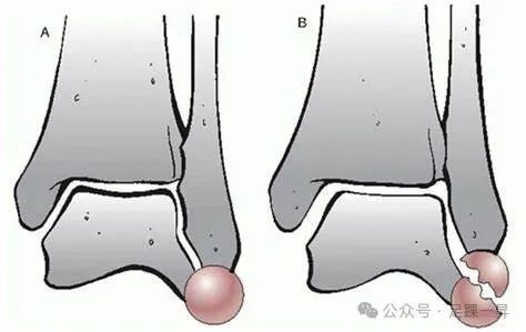 踝关节骨折——透视角度旋转对评估腓骨长度影响
