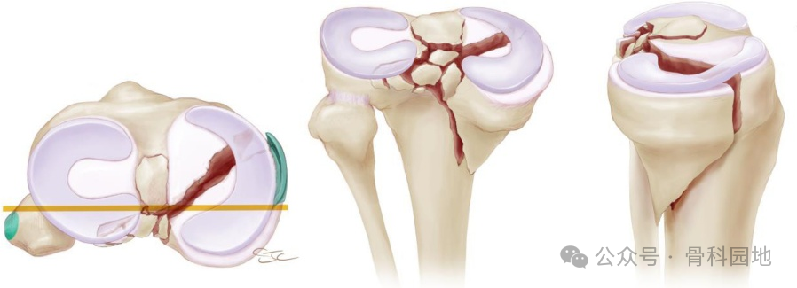 胫骨平台骨折的深度理解（经典文献回顾再学习总结）