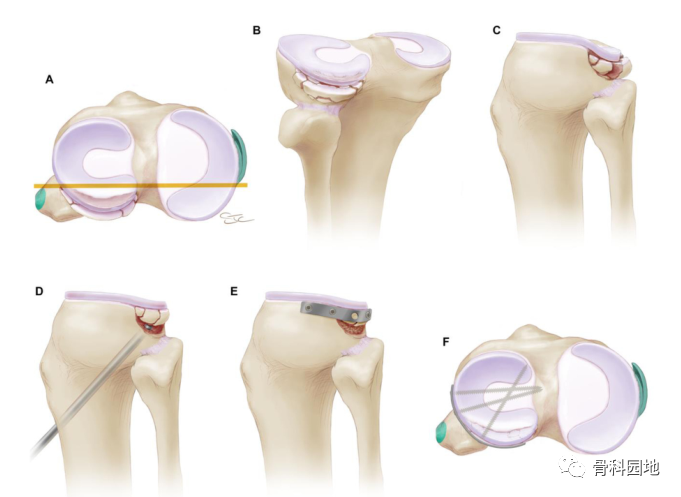 胫骨平台骨折的深度理解（经典文献回顾再学习总结）