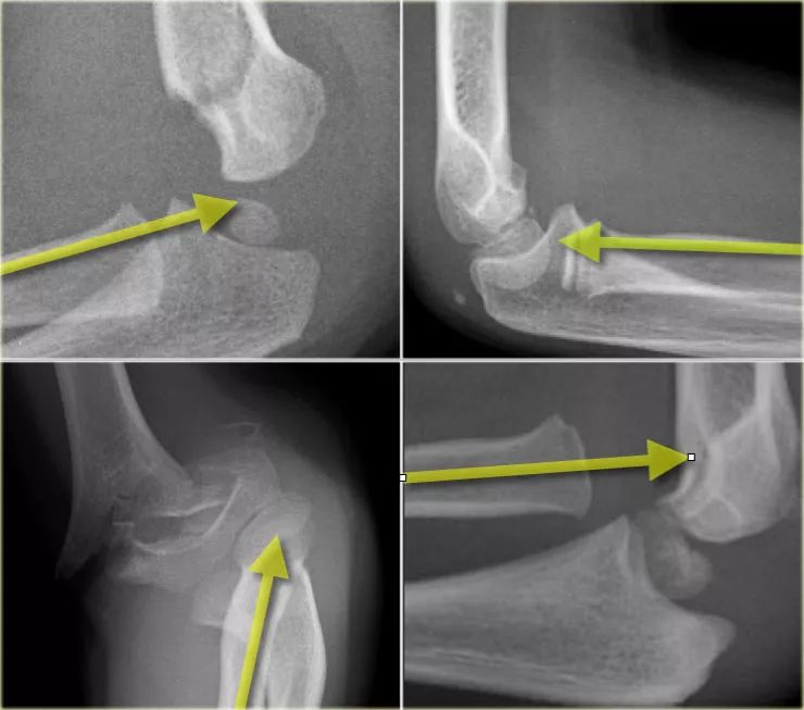 儿童肘关节骨折的X-线表现