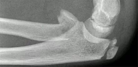 儿童肘关节骨折的X-线表现