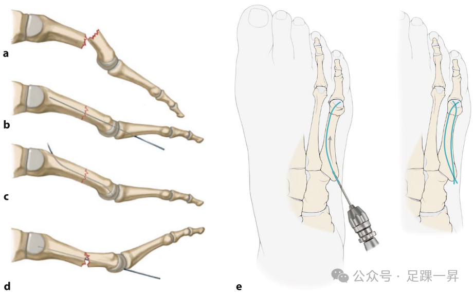 【手术技巧】第5跖骨干及跖骨颈骨折的手术治疗