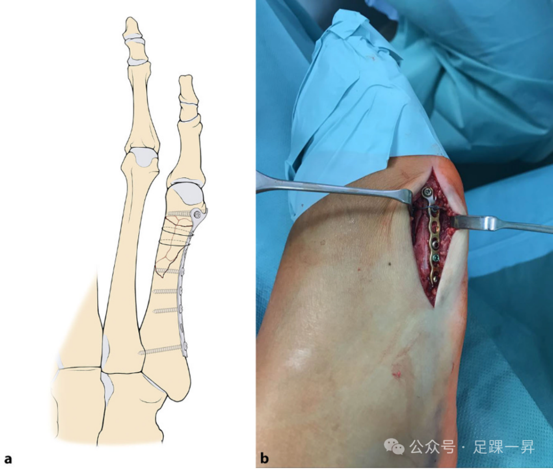 【手术技巧】第5跖骨干及跖骨颈骨折的手术治疗