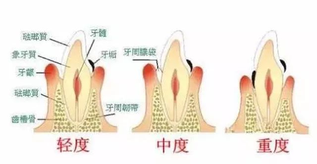 牙龈萎缩一定要治吗？