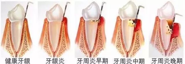 牙龈萎缩一定要治吗？