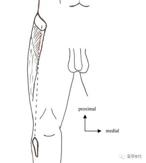 前入路髋关节置换的股外侧皮神经损伤