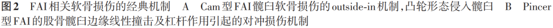 【骨科前沿】髋臼股骨撞击症髋臼软骨损伤的发生机制及诊疗进展