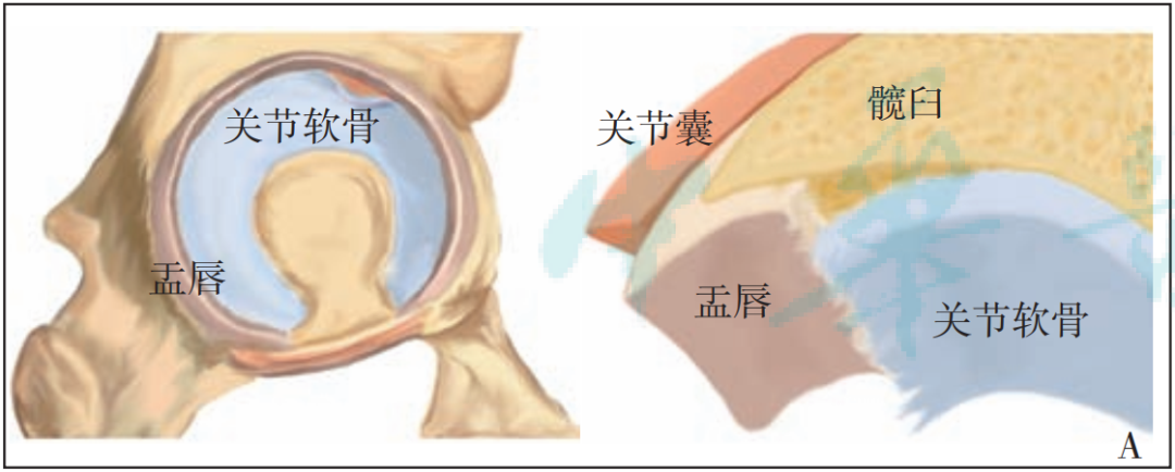 【骨科前沿】髋臼股骨撞击症髋臼软骨损伤的发生机制及诊疗进展