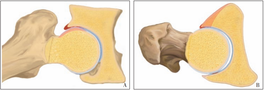 【骨科前沿】髋臼股骨撞击症髋臼软骨损伤的发生机制及诊疗进展