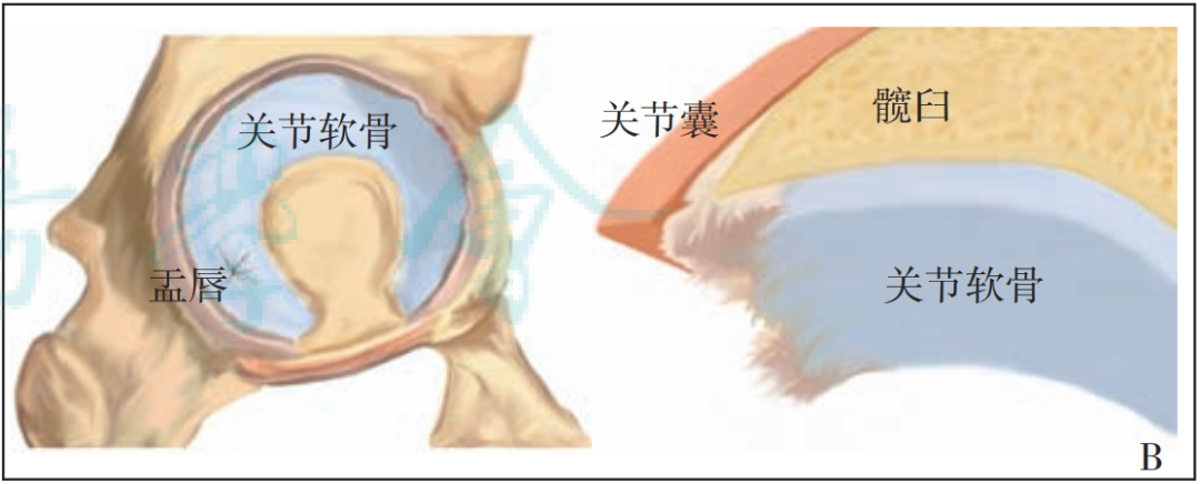 【骨科前沿】髋臼股骨撞击症髋臼软骨损伤的发生机制及诊疗进展