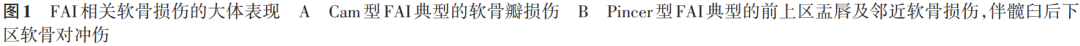 【骨科前沿】髋臼股骨撞击症髋臼软骨损伤的发生机制及诊疗进展