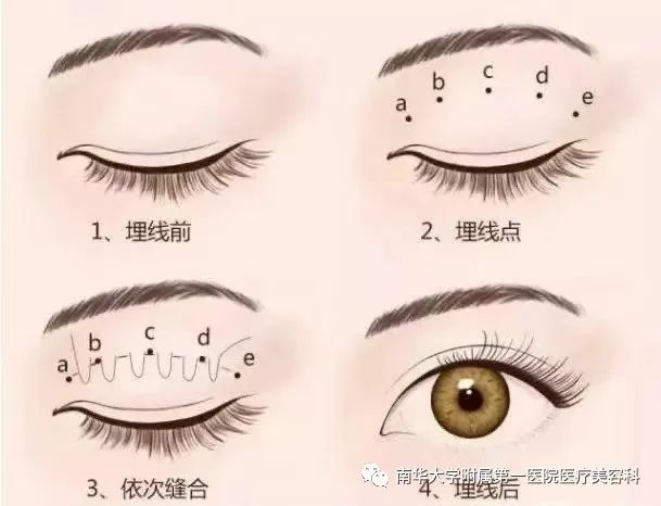 重睑术的手术方法和常见问题