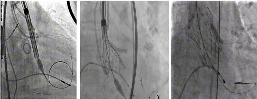 一文看懂经导管主动脉瓣置换术的临床诊疗策略进展