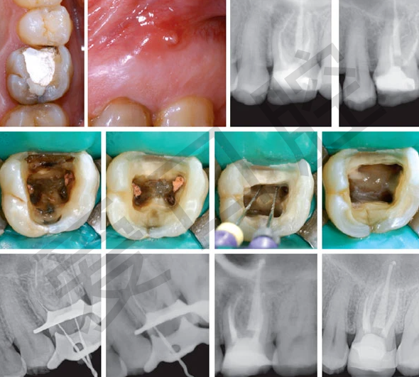 慢性根尖周炎的临床治疗方法