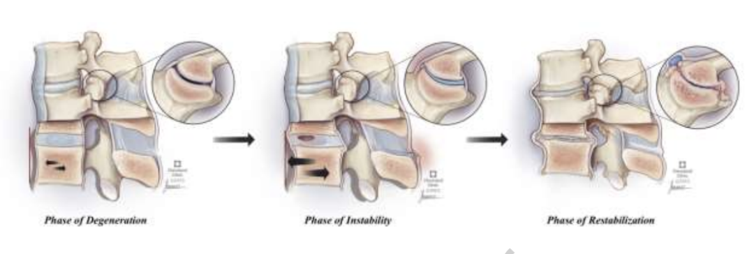 退行性腰椎滑脱症的影像学特征和自然演变