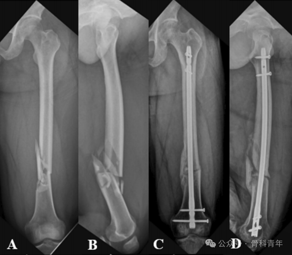 股骨干骨折骨不连的3种翻修方式，孰优孰劣？