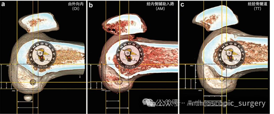 【手术技术】前交叉韧带重建中怎么样能精准的定位股骨隧道？