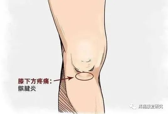 【盘点】膝痛不同位置，代表着的疾病