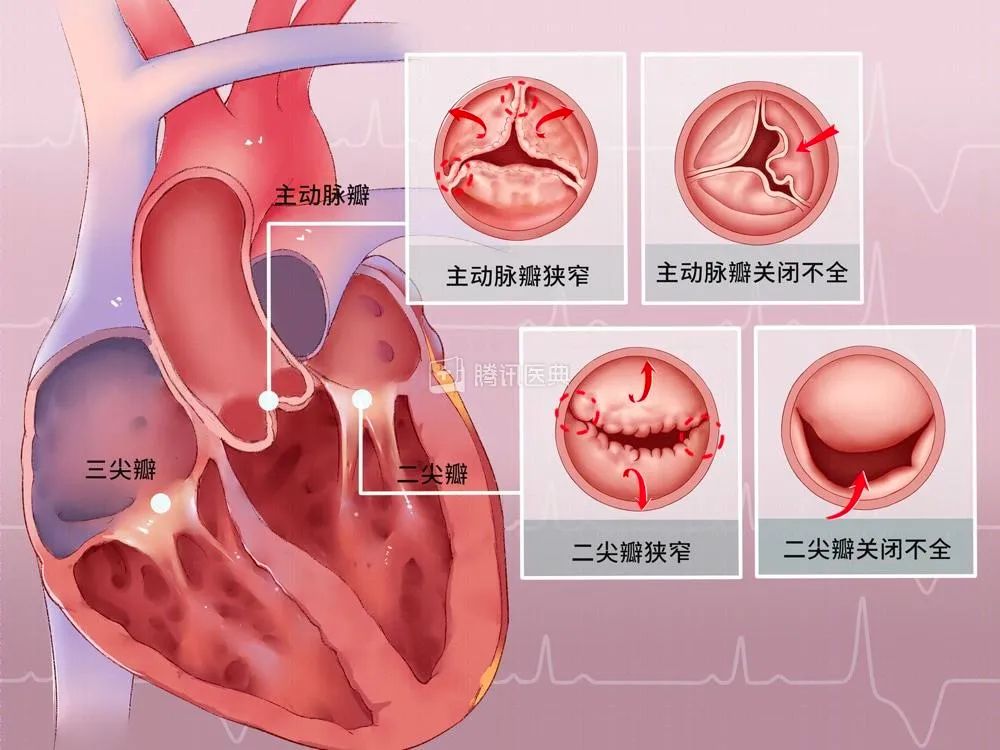 科普汇总：一文掌握心脏瓣膜病的关键