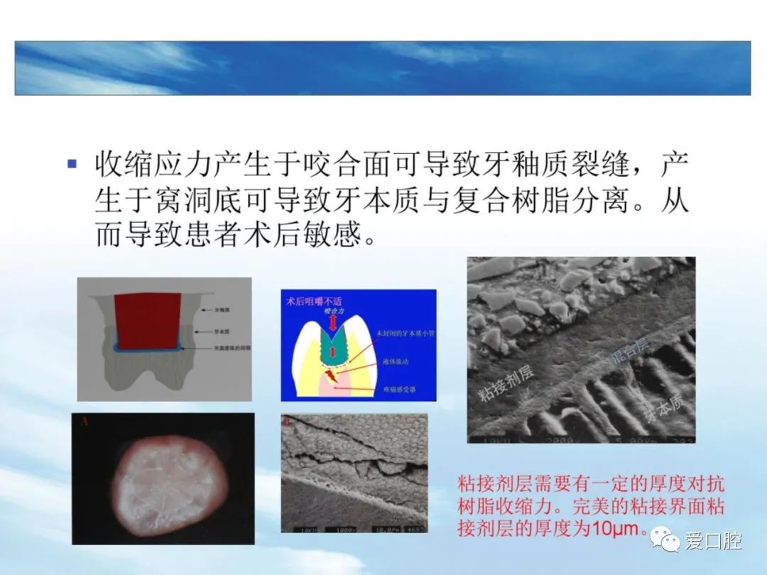 树脂充填后敏感的原因分析！