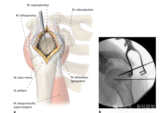 美图详解肱骨近端骨折微创钢板治疗的步骤技巧