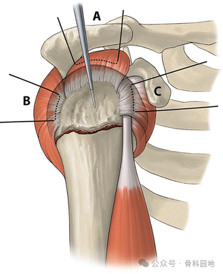 美图详解肱骨近端骨折微创钢板治疗的步骤技巧