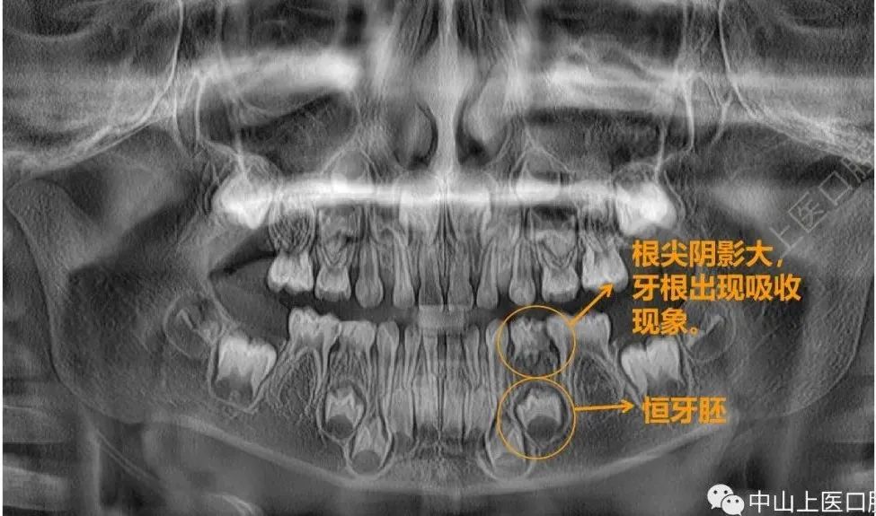 儿童牙龈反复长脓包怎么办？