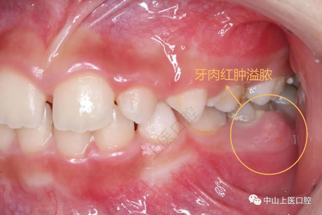 儿童牙龈反复长脓包怎么办？