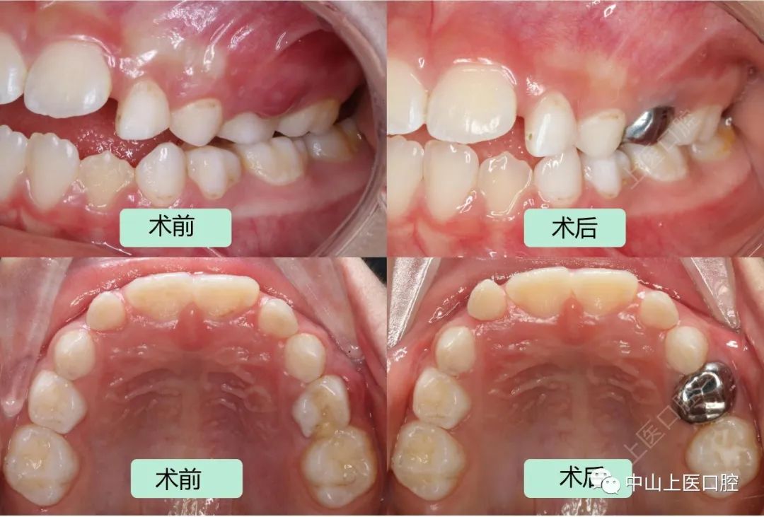 儿童牙龈反复长脓包怎么办？