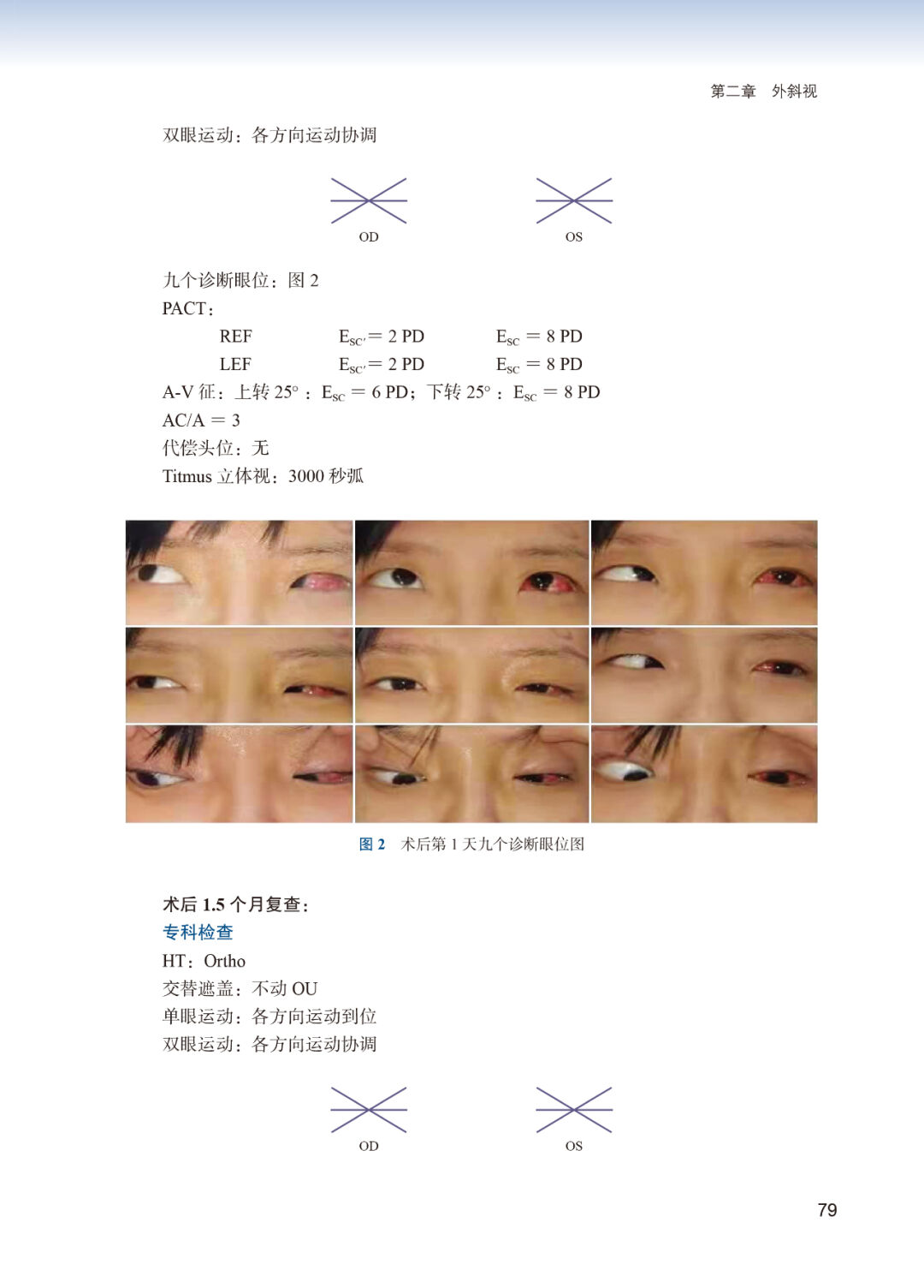 新书上架：新版-斜视经典病例解析