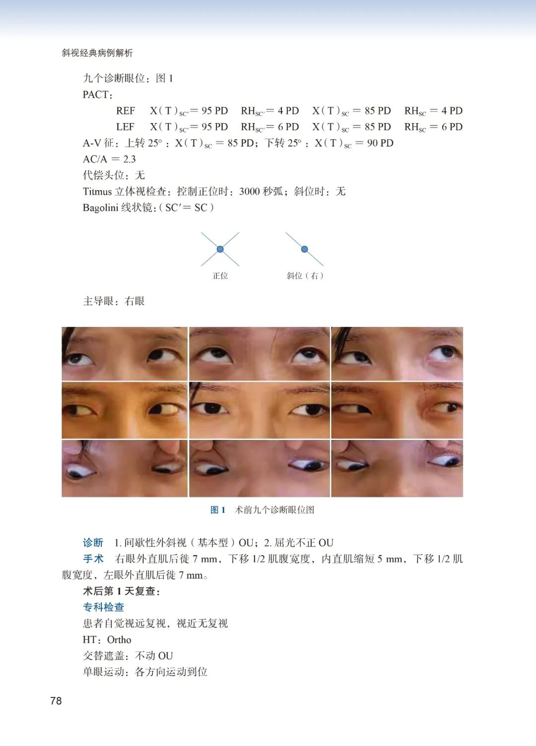 新书上架：新版-斜视经典病例解析