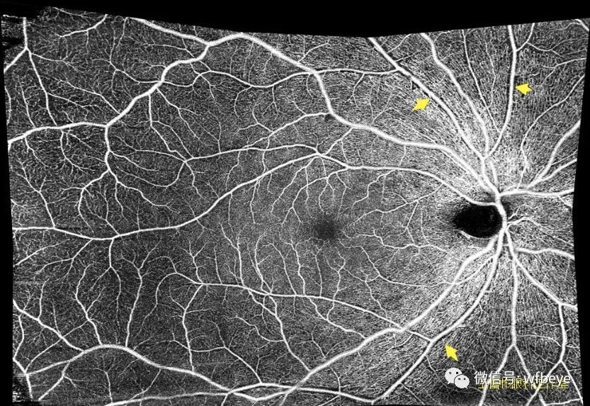 OCTA：视网膜动脉“黑鞘”，与“白鞘”大相径庭
