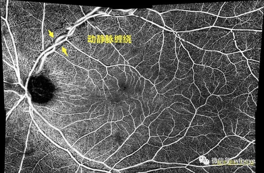 OCTA：视网膜动脉“黑鞘”，与“白鞘”大相径庭
