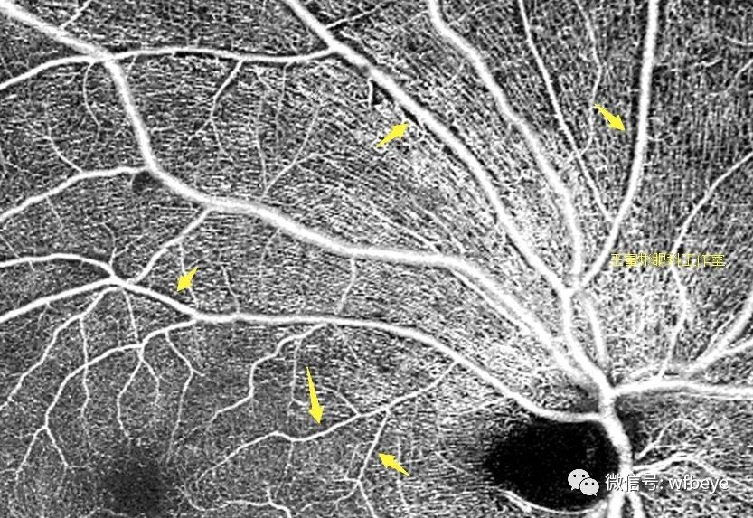 OCTA：视网膜动脉“黑鞘”，与“白鞘”大相径庭