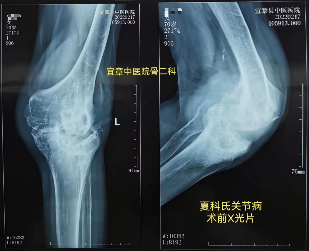 夏科膝关节病关节病的RK旋转铰链膝置换术